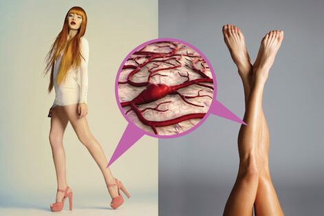 Varices on the legs