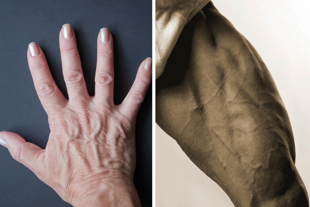 Varicose symptoms