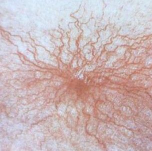 Teangiectasia