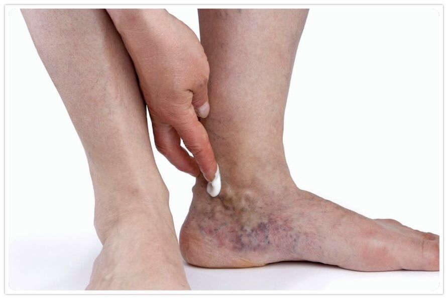 The advantages of the veins procedure