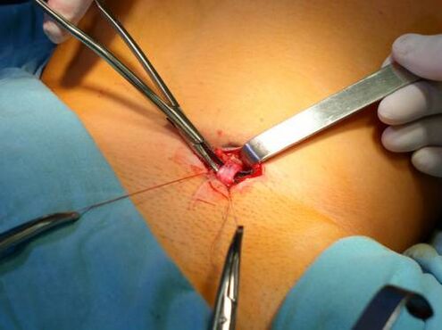 Fubletomy