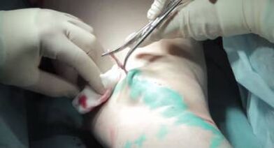 Surgery
