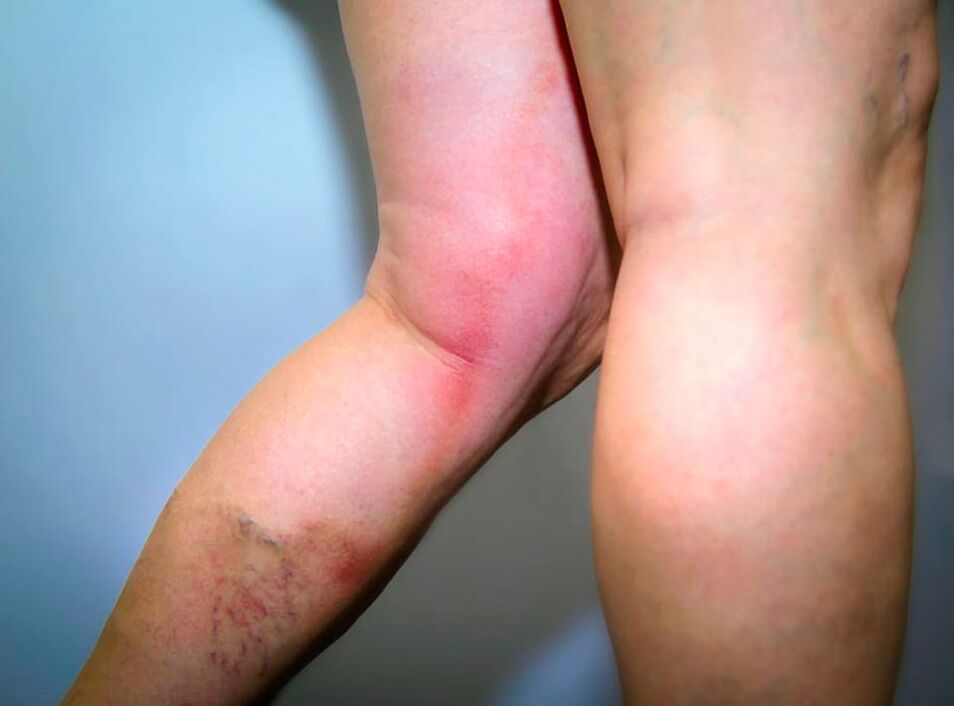 The consequences of varicose veins