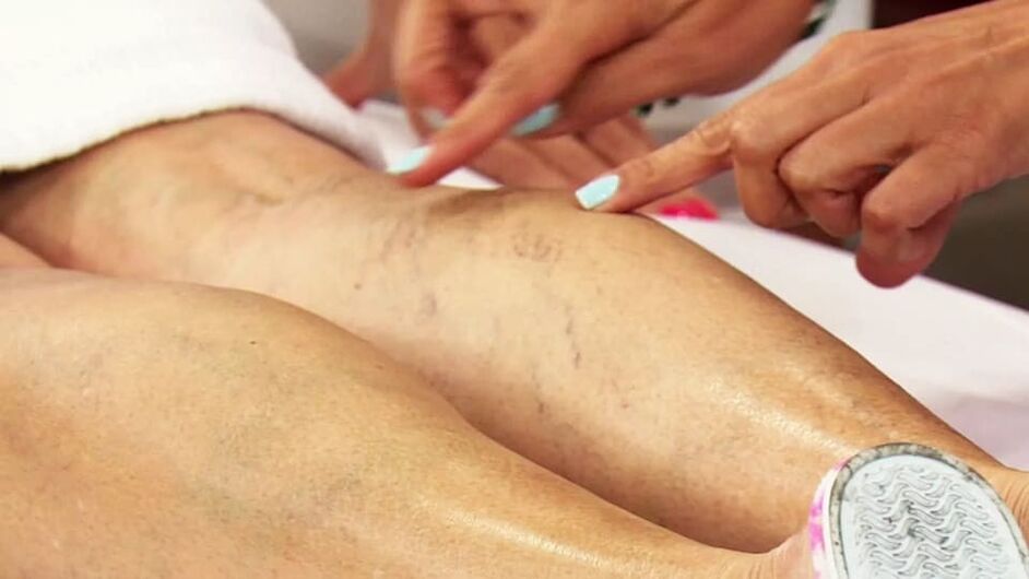 Varices on the bottom of the leg