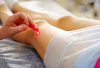 Varice laser treatment