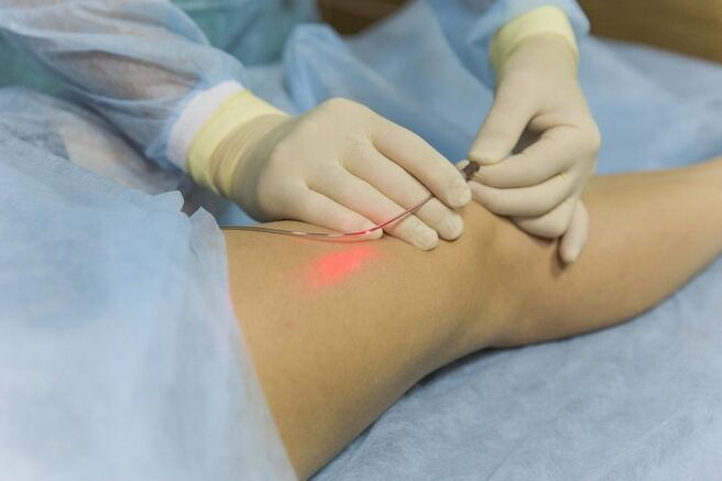 Laser treatment for varicose veins