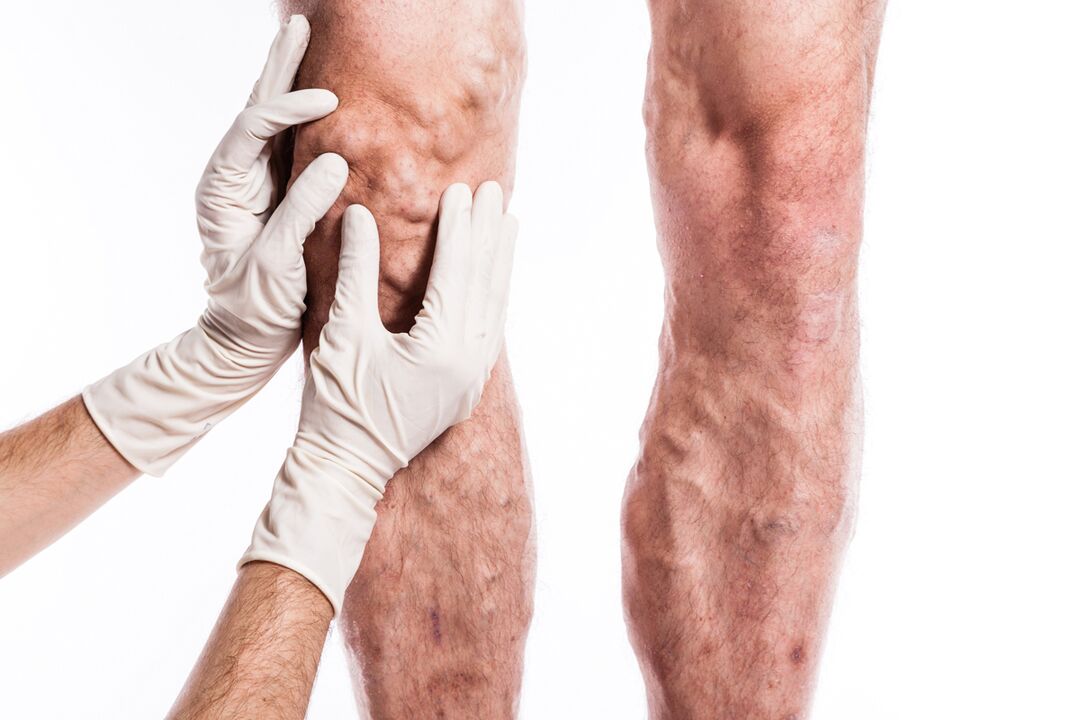 The phlebologist examines the legs of a patient suffering from varicose veins
