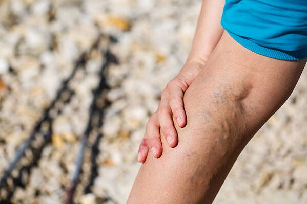 varicose veins of the legs