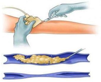 Sclerotherapy is a method of treating varicose veins