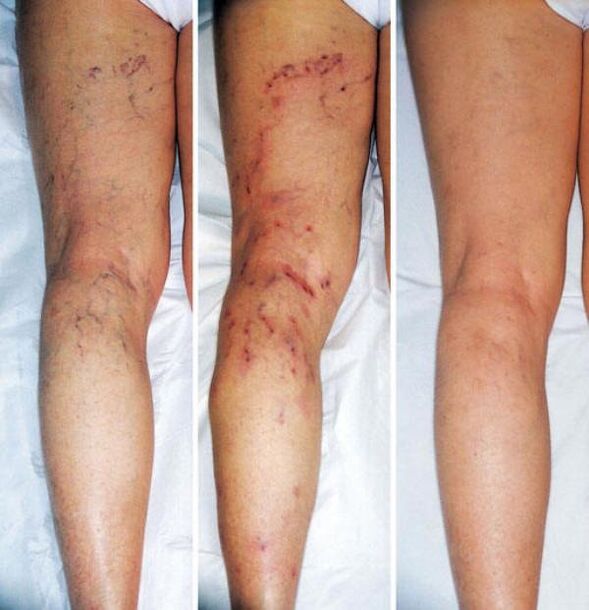 stages of varicose veins of the lower limbs