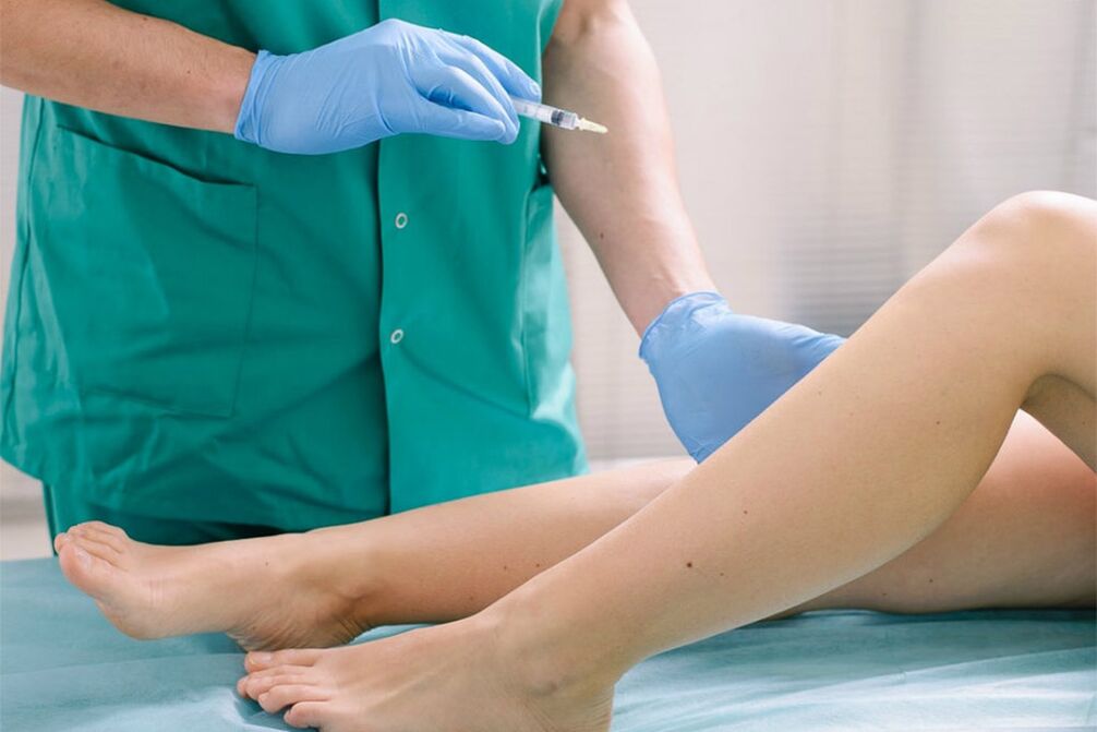 sclerotherapy for the elimination of varicose veins