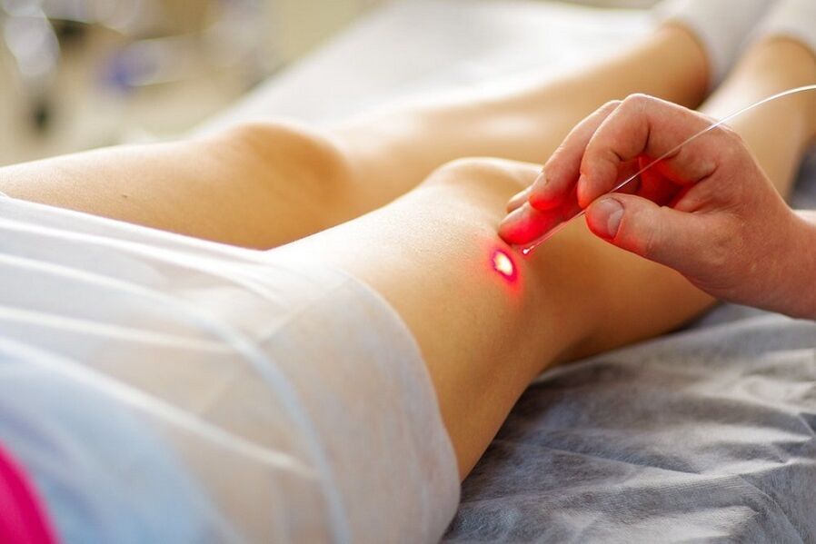 laser treatment for varicose veins