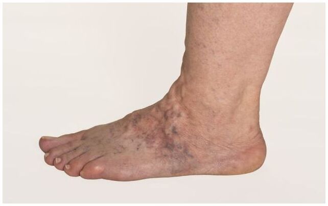 Varicose veins on a man's leg, complicated with trophic ulcers