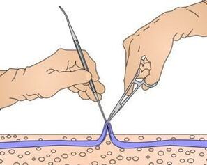 Miniphlebectomy - removal of the part of the vein affected by the varicose veins