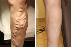 The result of the operation to remove varicose veins from the legs