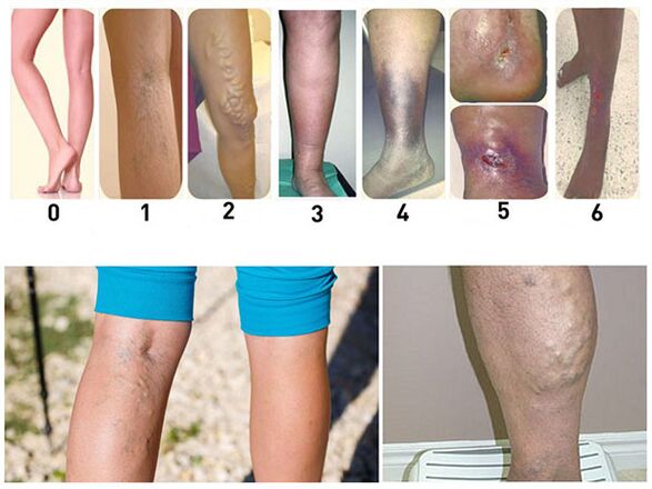 Stages of development of varicose veins of the lower limbs