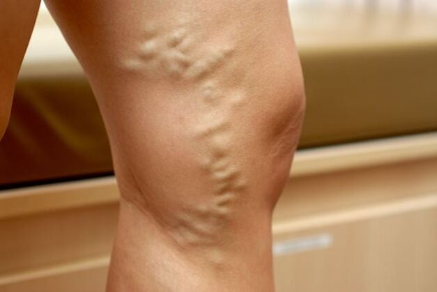 Protruding distorted vein on the leg with stage 3 varicose veins