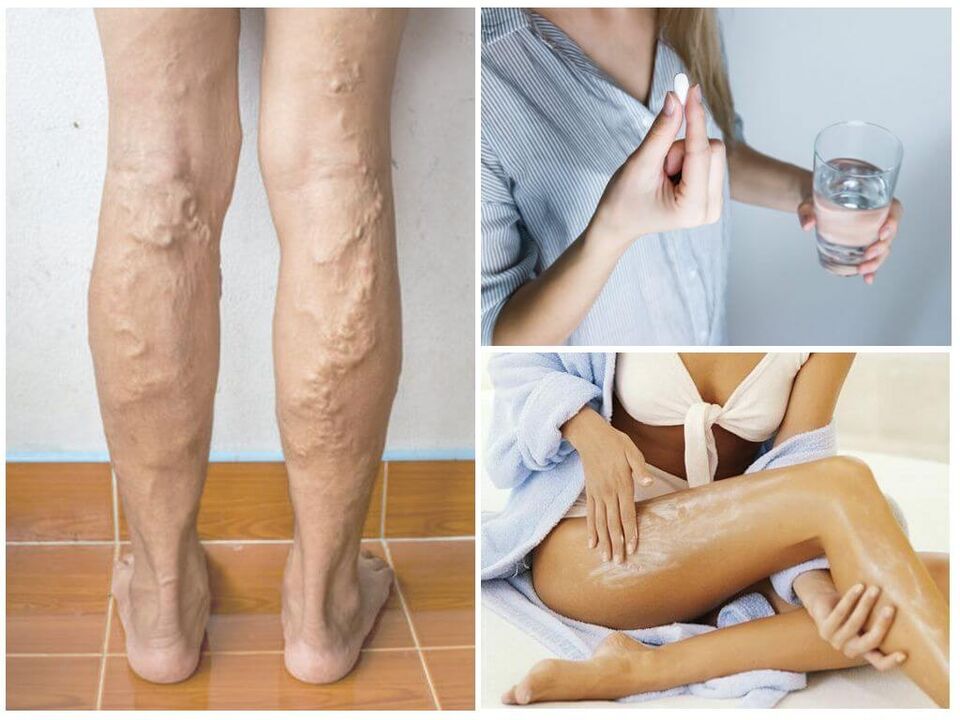 Varicose veins of the lower extremities and treatment methods