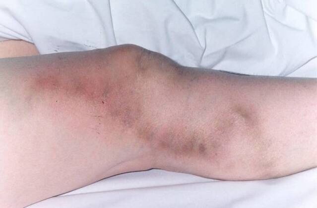 thrombophlebitis with advanced varices