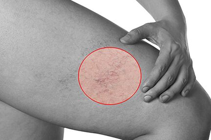 Telangiectasia in varicose veins of the lower limbs