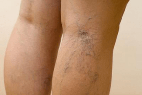 photo of varicose veins on the legs